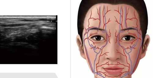 Wireless Palm Ultrasound Used in Plastic Surgery