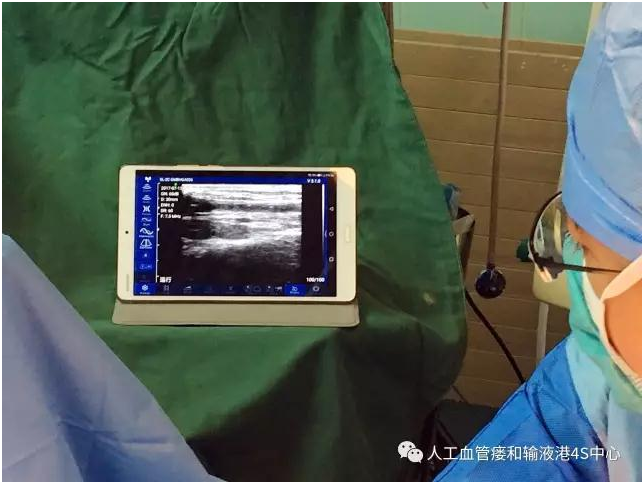 无线制导技术延续透析生命线无限生机 ——中国首例无线便携式B超引导下透析通路腔内成型术在北京大学第一医院血管外科顺利完成
