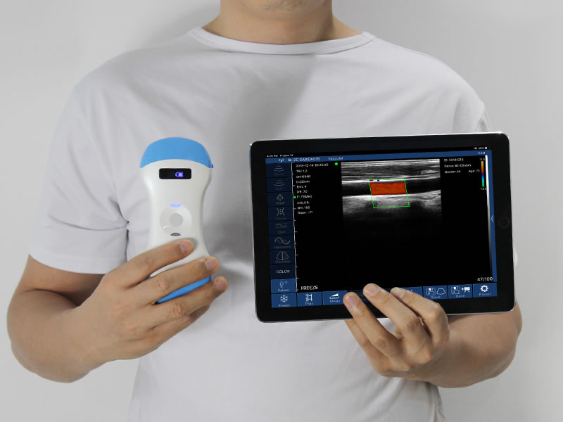 Wireless Handheld Pocket Ultrasound vs. Traditional Cart-Based Ultrasound: What Are the Differences